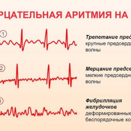 Сердечный ритм в опасности: что нужно знать об аритмии