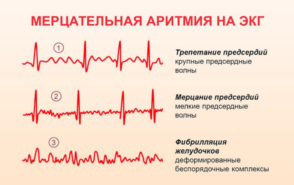 Preview Сердечный ритм в опасности: что нужно знать об аритмии