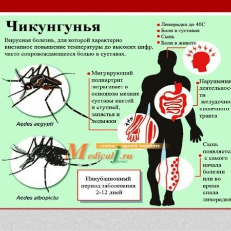 Лихорадка чикунгунья: подробное руководство