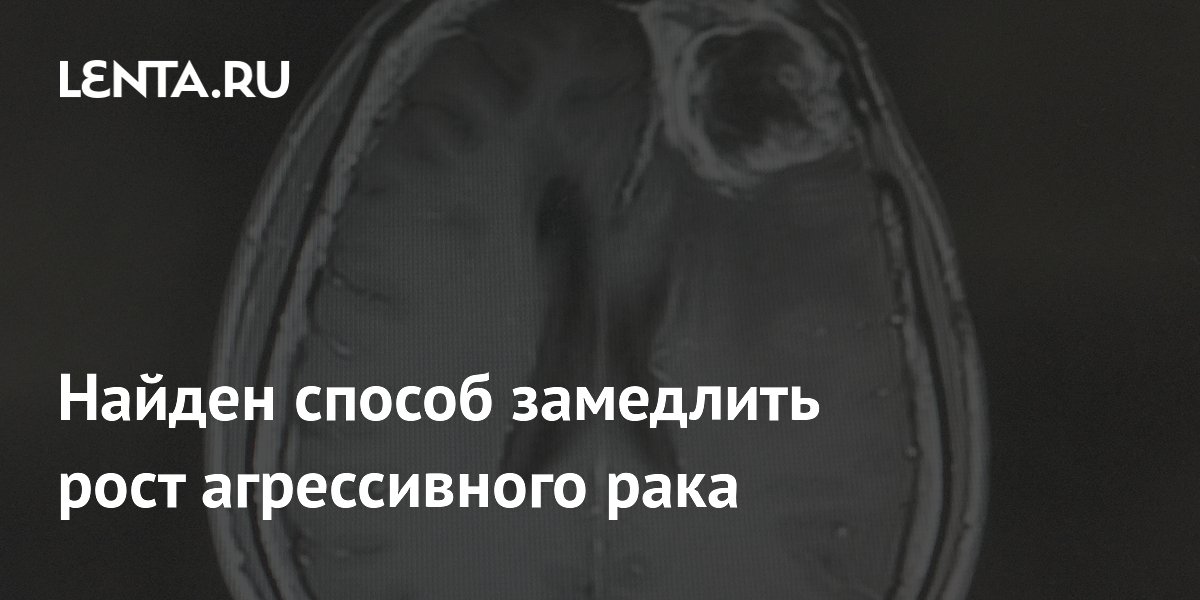 Preview Обнаружен метод замедления роста агрессивного рака мозга