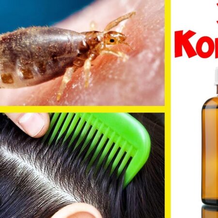 Вши у ребенка: что делать и как избавиться от педикулеза