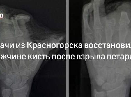 Реконструкция ладони после взрыва петарды: хирурги использовали ткань с живота пациента