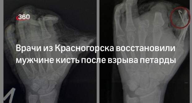 Preview Реконструкция ладони после взрыва петарды: хирурги использовали ткань с живота пациента