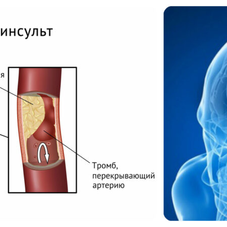 ДМТ: Неожиданный защитник мозга при инсульте