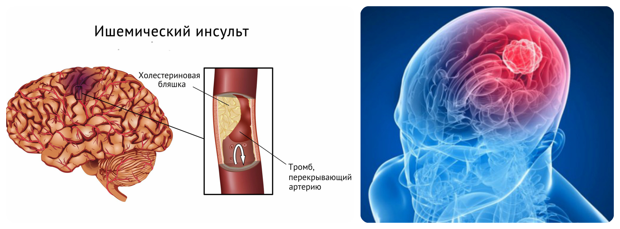 Preview ДМТ: Неожиданный защитник мозга при инсульте