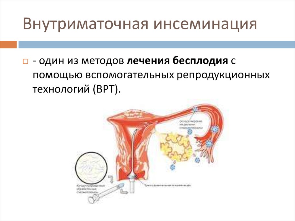 Preview Прорыв в лечении бесплодия: мРНК-технология подарила надежду
