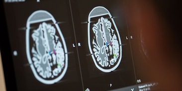 Исследователи выявили биологический маркер ускоренного старения мозга, связанный с тревожными расстройствами